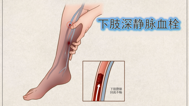 卧床不&ldquo;躺平&rdquo;，健康动起来：下肢深静脉血栓的预防